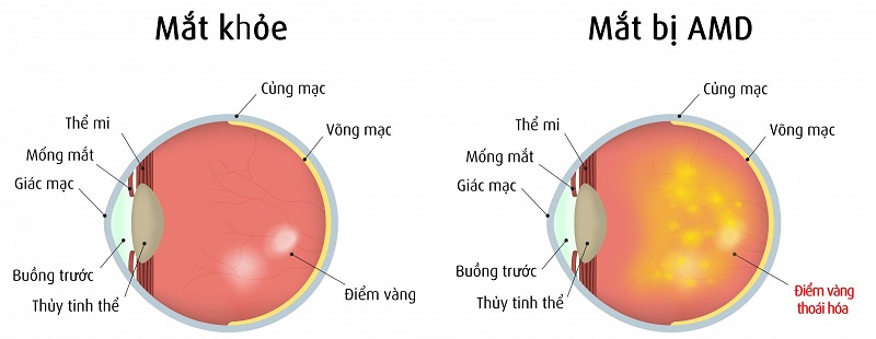 Bệnh lý nguy hiểm: Thoái hóa điểm vàng (ARMD hoặc AMD)