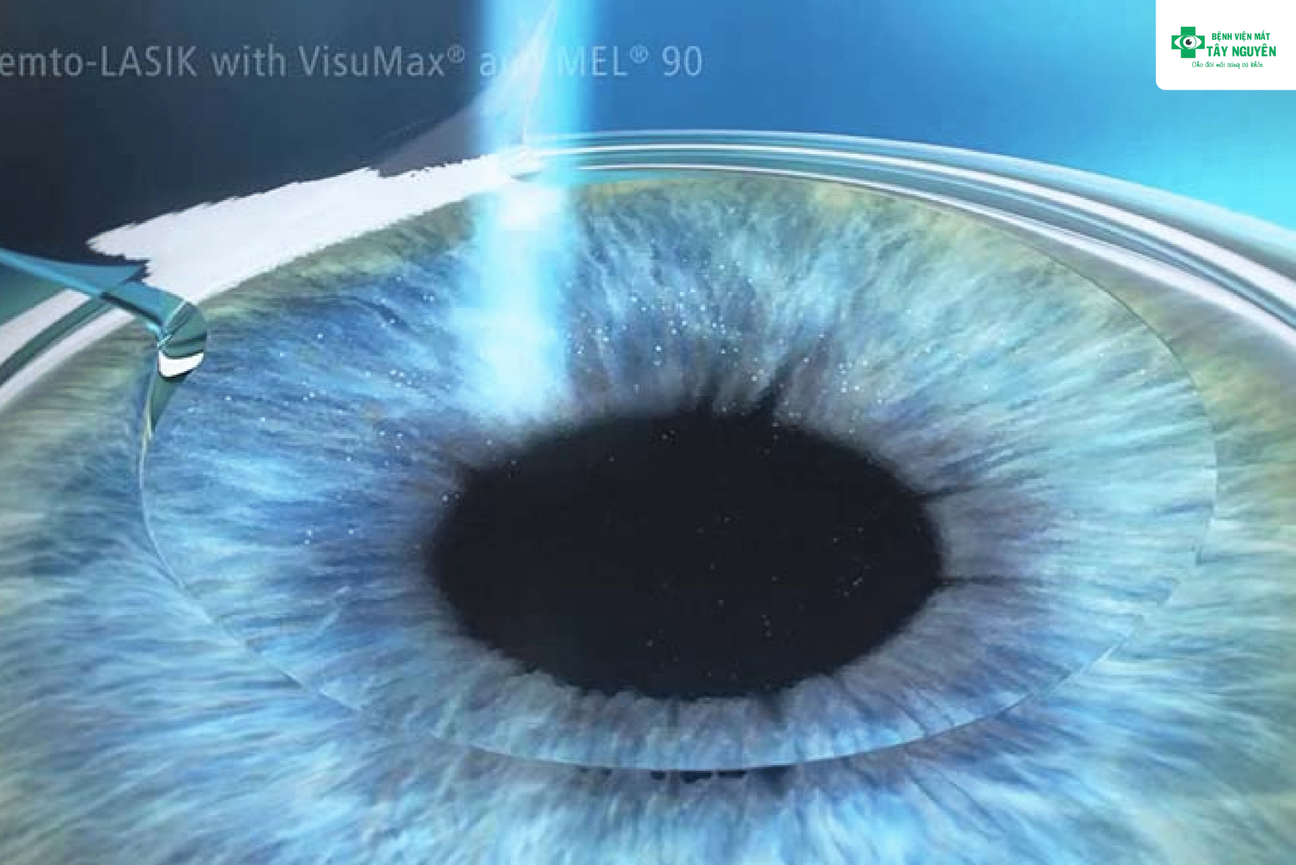 Femto LASIK – Giải pháp cho những ai xóa cận nhưng sợ đau