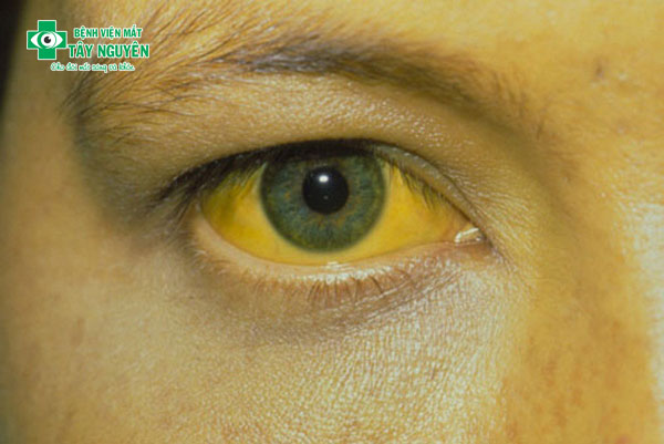 Hình ảnh bệnh về gan