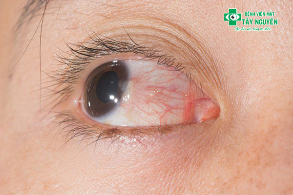 Đôi mắt báo hiệu những vấn đề về sức khỏe