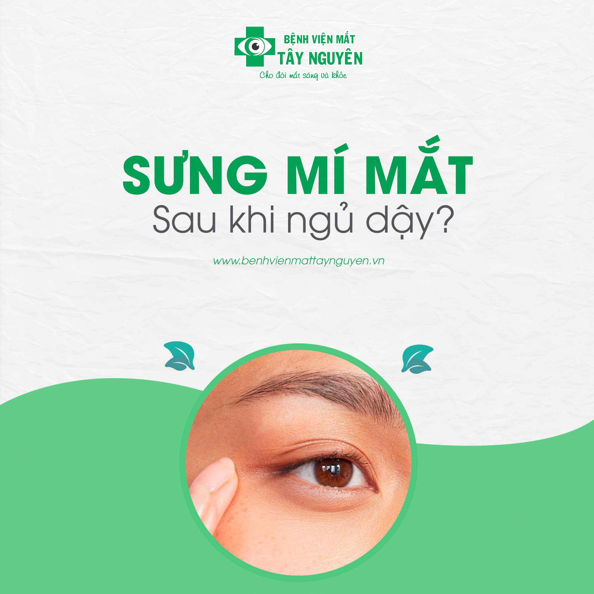 sưng mắt sau khi ngủ dậy