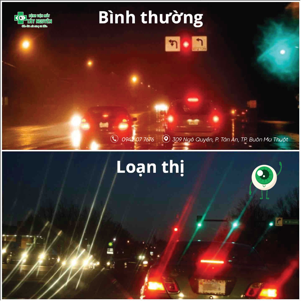Hình ảnh Loạn thị Bệnh viện mắt Tây Nguyên