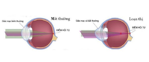 loạn thị nguyên nhân và cách điều trị