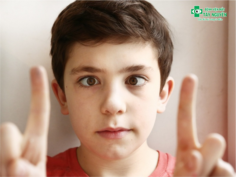 Qua quan sát thông thường cũng có thể nhận biết bệnh mắt lác (lé).