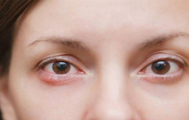 Hình ảnh bị lẹo mắt