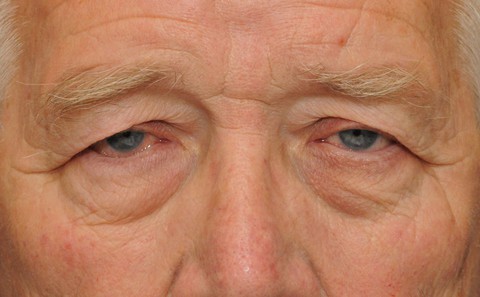 Sụp mi ở người lớn